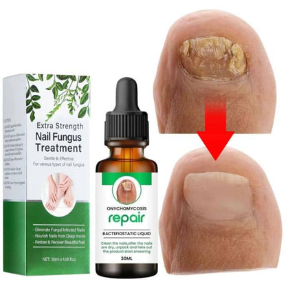 NailFix Nails Strong Growth And Repair Oil (Buy 1 Get 1 FREE)